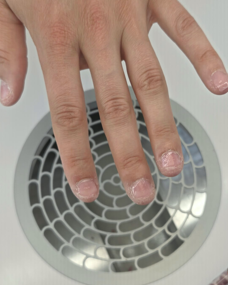 Abrissige Nägel mit angegriffener Nagelhaut vor der Nagelmodellage